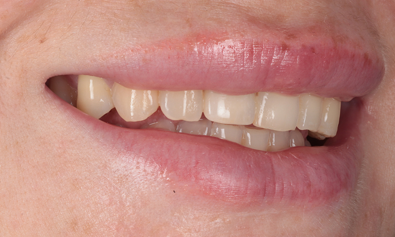 Before - Lakewood Dental