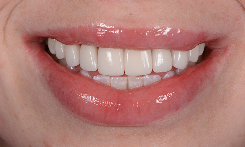 After - Lakewood Dental
