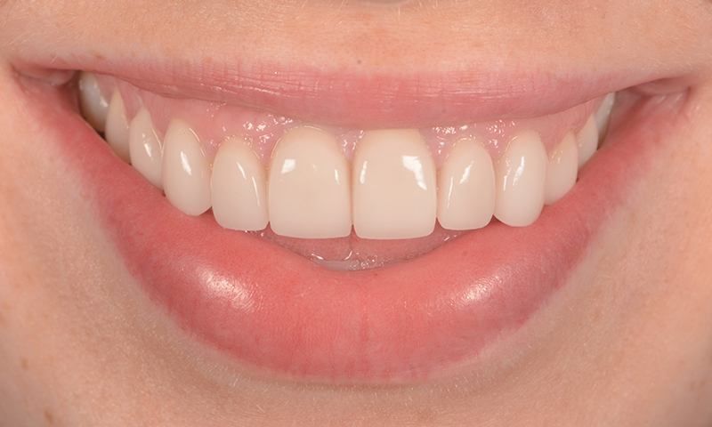 Before - Lakewood Dental