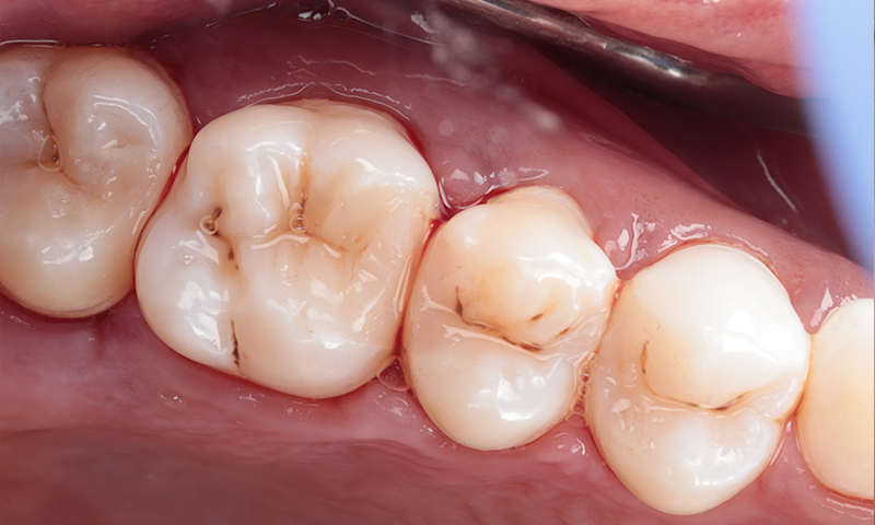 After - Lakewood Dental