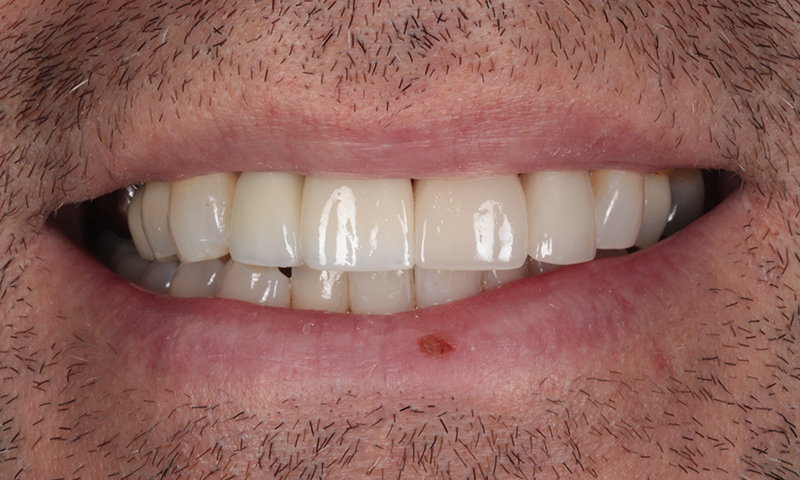 After - Lakewood Dental