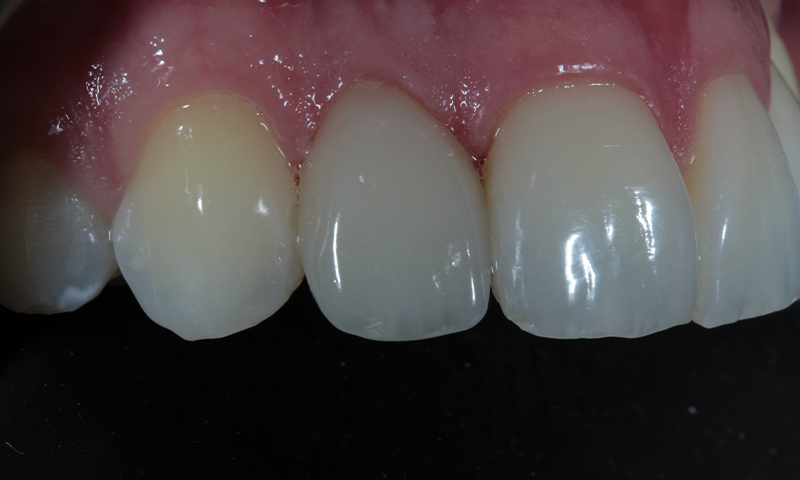 After - Lakewood Dental