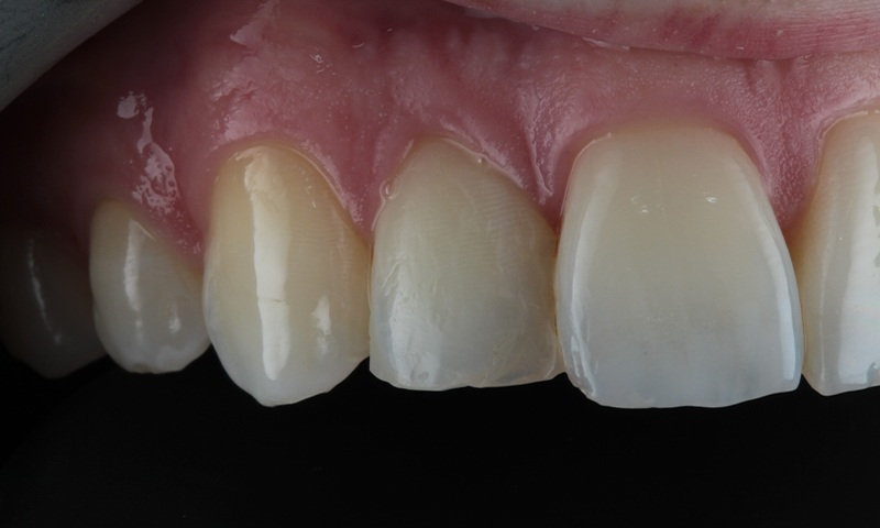 Before - Lakewood Dental