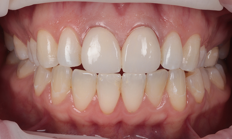 After - Lakewood Dental