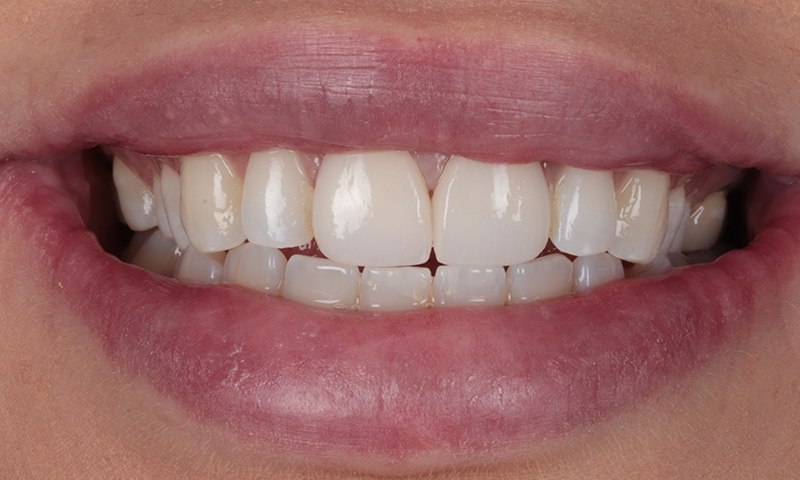 After - Lakewood Dental