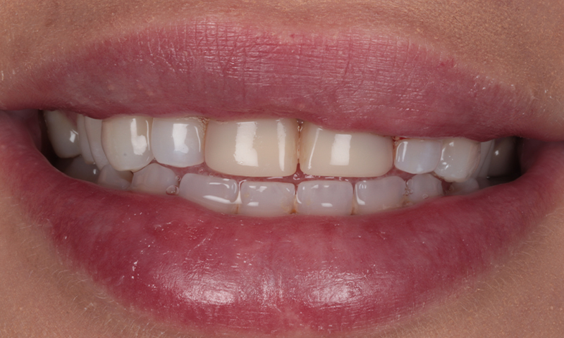 Before - Lakewood Dental