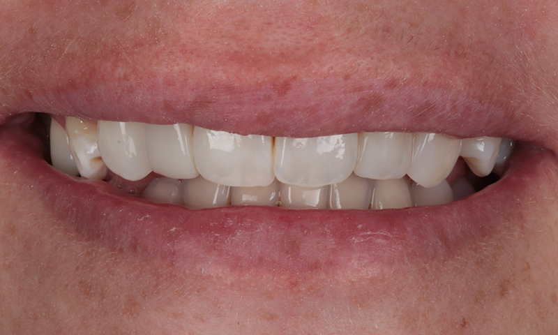 After - Lakewood Dental