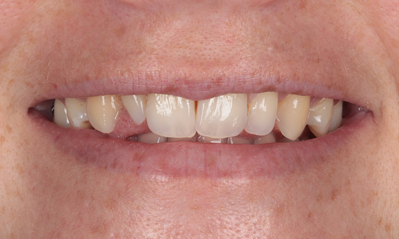 Before - Lakewood Dental
