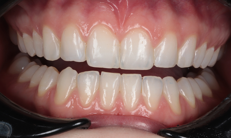 After - Lakewood Dental