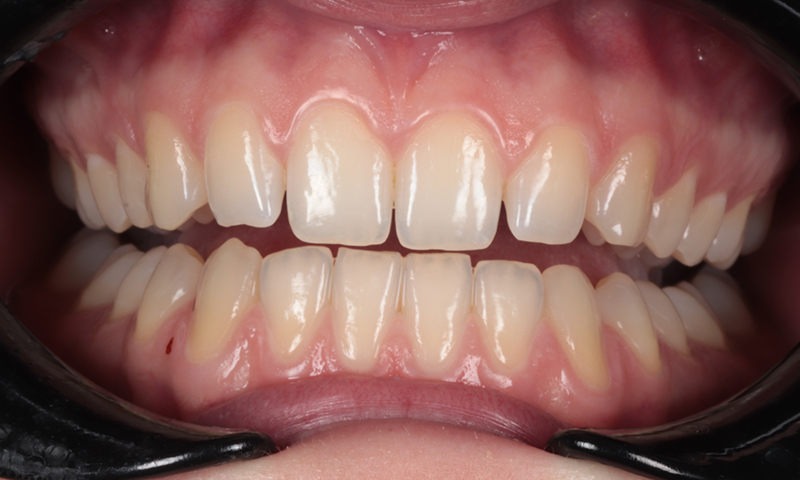 Before - Lakewood Dental