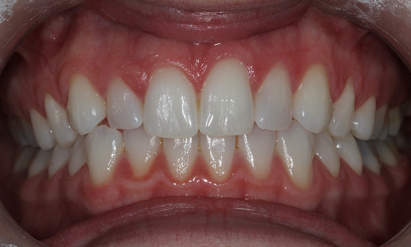 After - Lakewood Dental