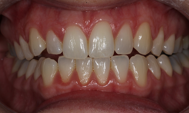 Before - Lakewood Dental