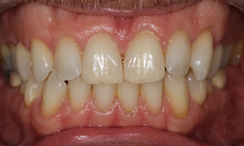 After - Lakewood Dental